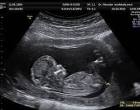 Ministério Público pede uso de anestesia em bebês abortados com cloreto de potássio